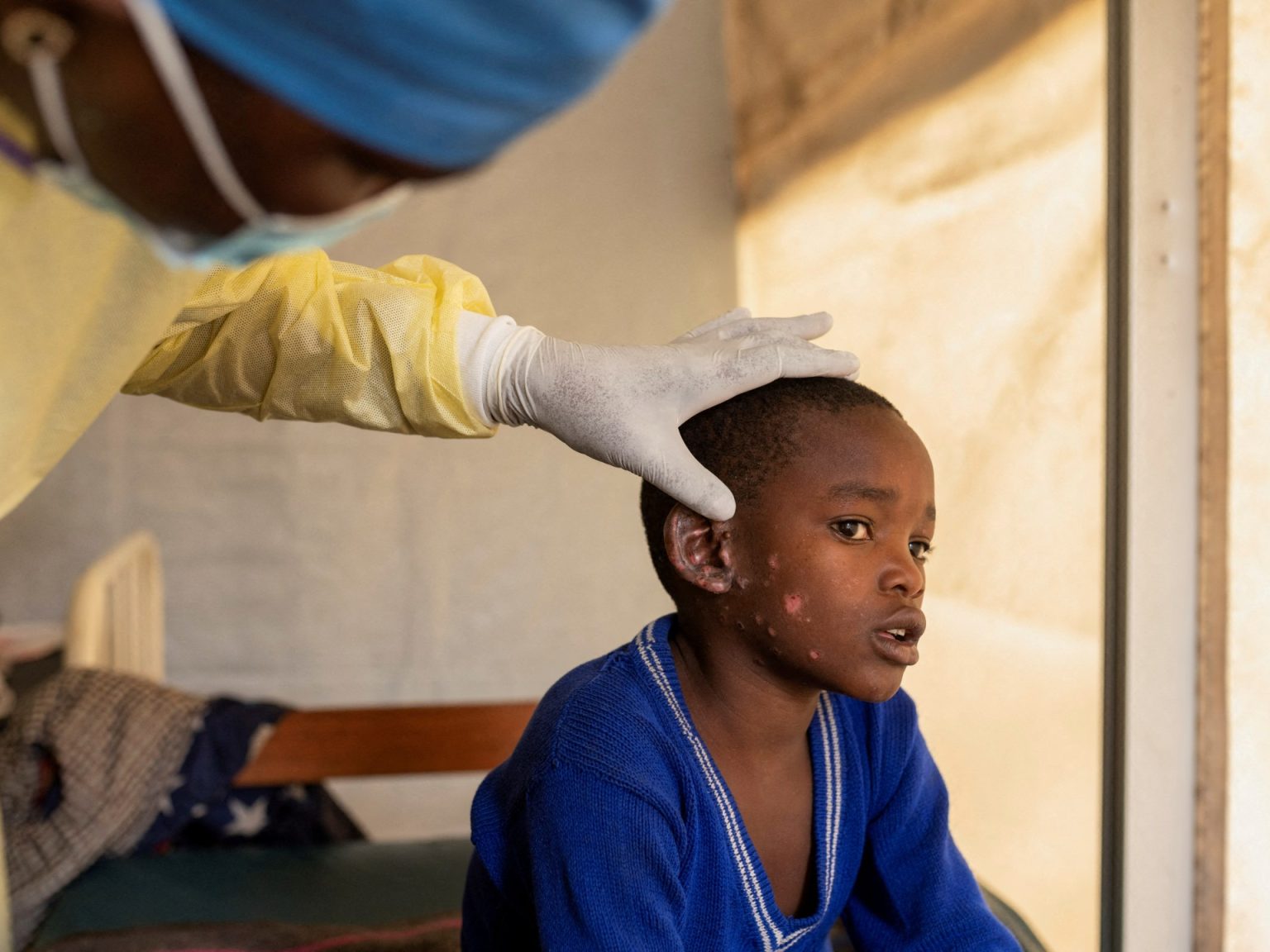 Sweden confirms first case of mpox pressure outdoors Africa | Well being Information