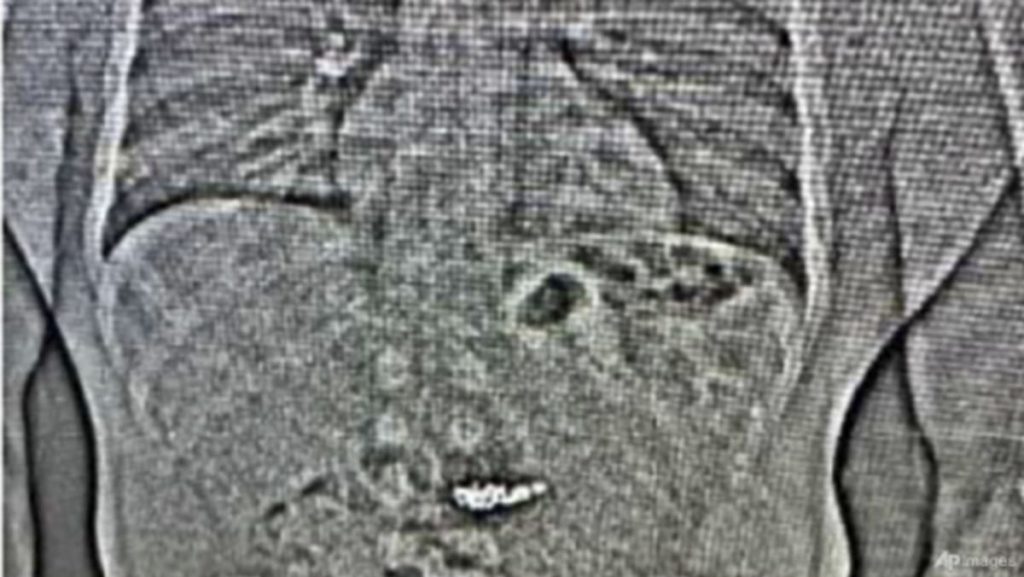 X-ray exhibits US0,000 diamond earrings swallowed by theft suspect throughout arrest: US police X-ray exhibits US0,000 diamond earrings swallowed by theft suspect throughout arrest: US police