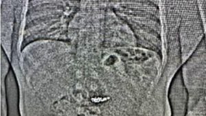 X-ray exhibits US0,000 diamond earrings swallowed by theft suspect throughout arrest: US police