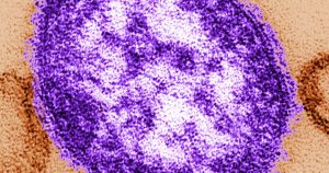Sturdy reporting is a reminder that even a light measles case can result in severe illness, mobile injury